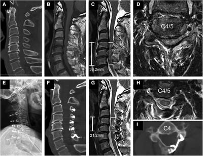 Early expansive single sided laminoplasty decompression treatment severe traumatic cervical spinal cord injury